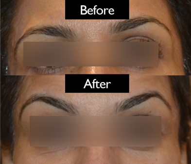 brow-patient5